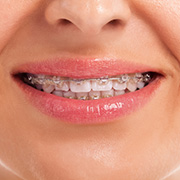 Detail of woman's mouth smiling and wearing metal braces