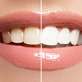 Detail of a woman's mouth smiling, half of the mouth shows slightly darker teeth and the other half shows white teeth