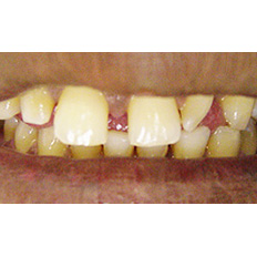 Detail of man's smile with space between yellow teeth