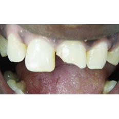 Detail of smile with broken upper right front tooth