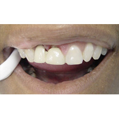 Detail of a man's mouth with black particles in the gums and a water sucker in the mouth